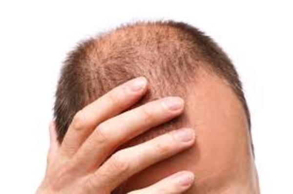Large queda de cabelo